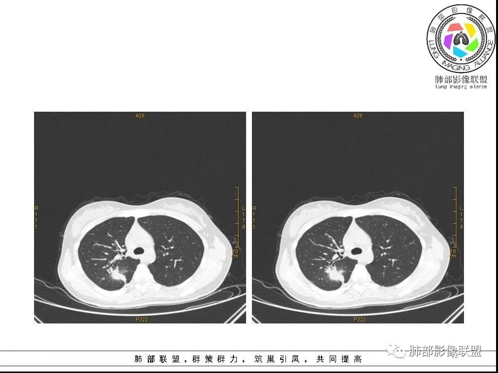【病例】右肺炎症性病变1例CT影像讨论