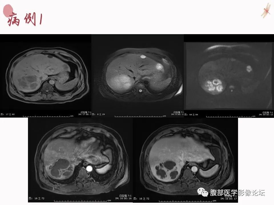 【PPT】肝脏良性囊肿影像诊断