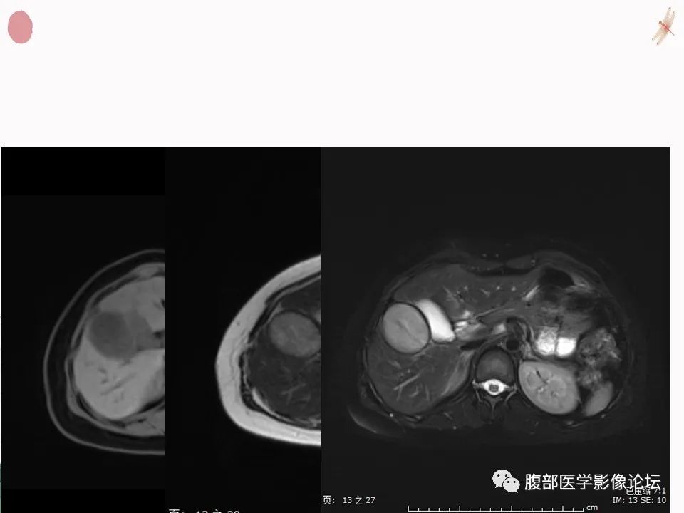 【PPT】肝脏良性囊肿影像诊断