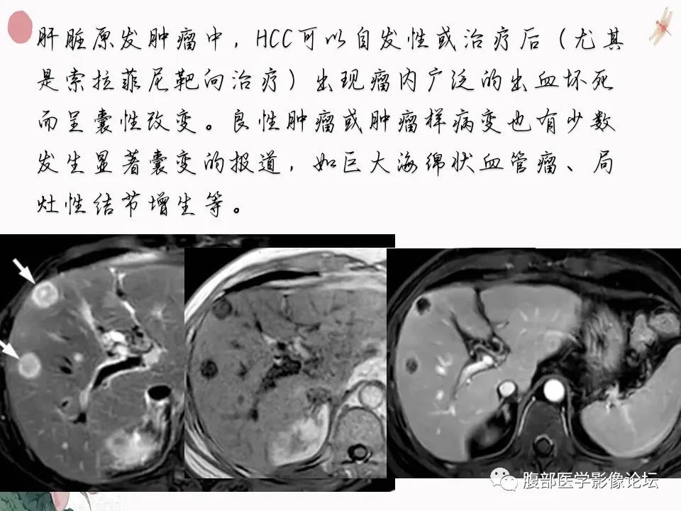 【PPT】肝脏良性囊肿影像诊断