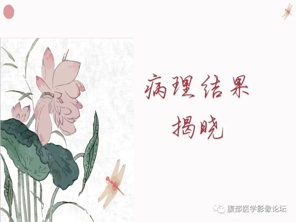 【PPT】肝脏良性囊肿影像诊断