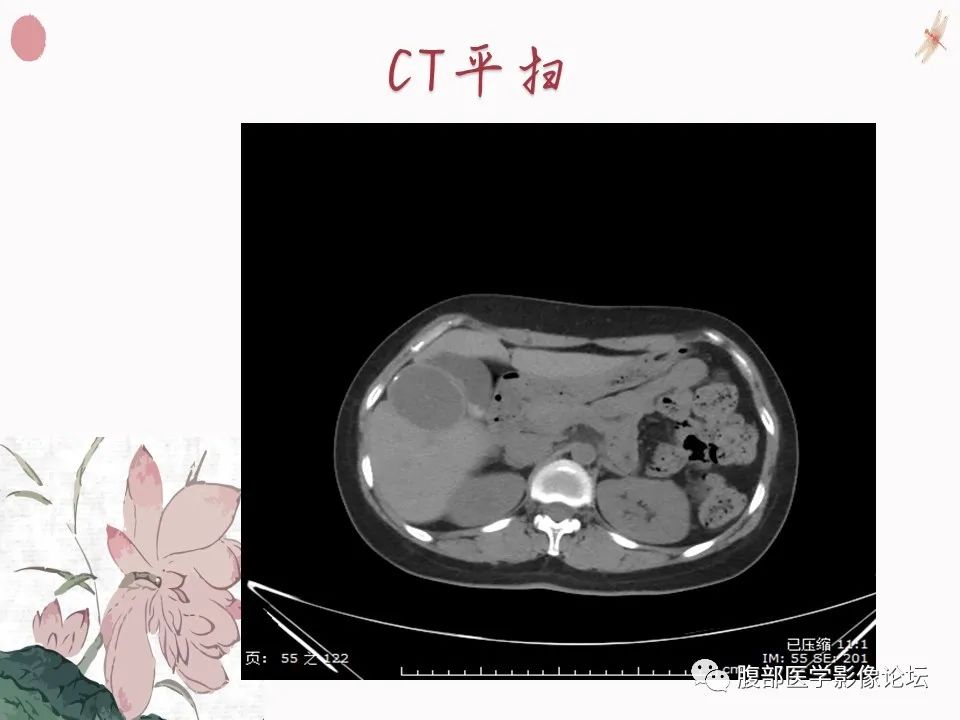 【PPT】肝脏良性囊肿影像诊断