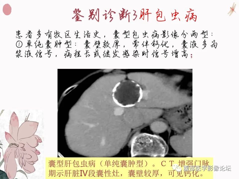 【PPT】肝脏良性囊肿影像诊断
