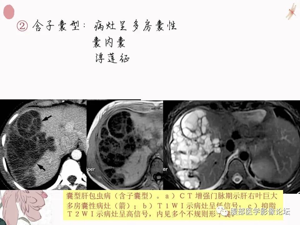 【PPT】肝脏良性囊肿影像诊断
