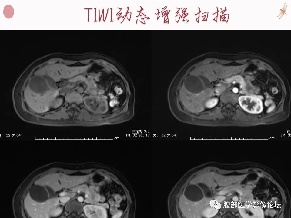 【PPT】肝脏良性囊肿影像诊断