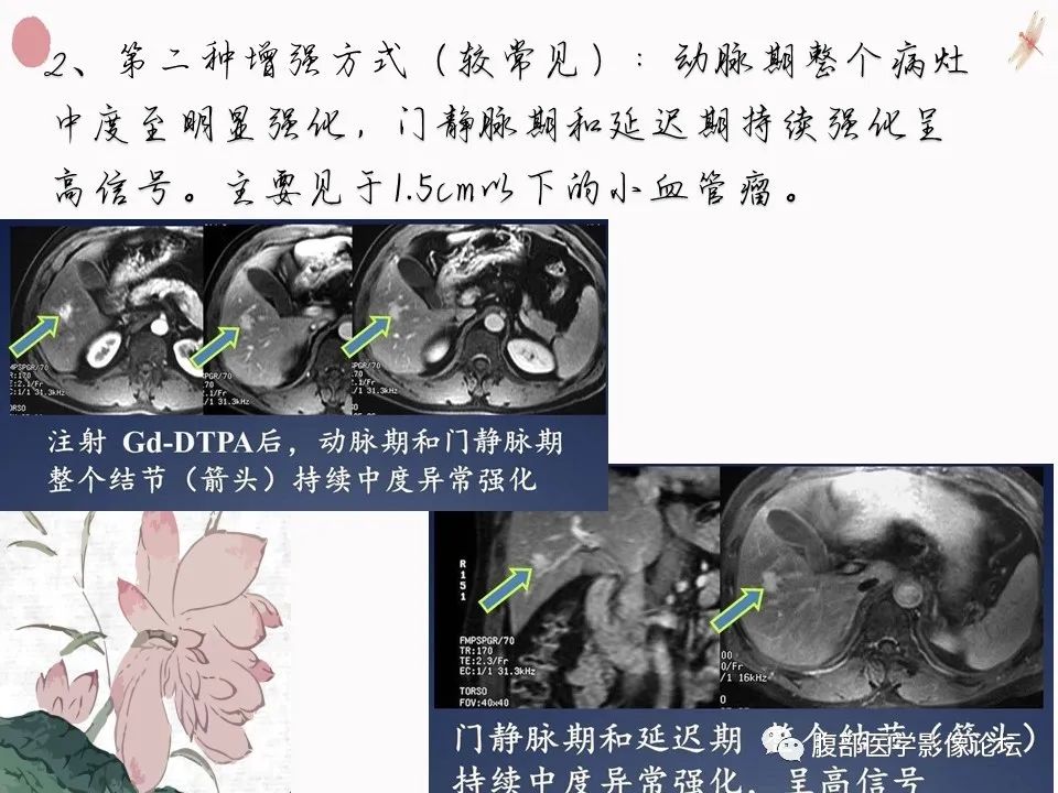 【PPT】肝脏良性囊肿影像诊断