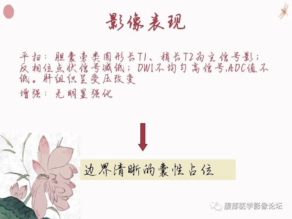 【PPT】肝脏良性囊肿影像诊断