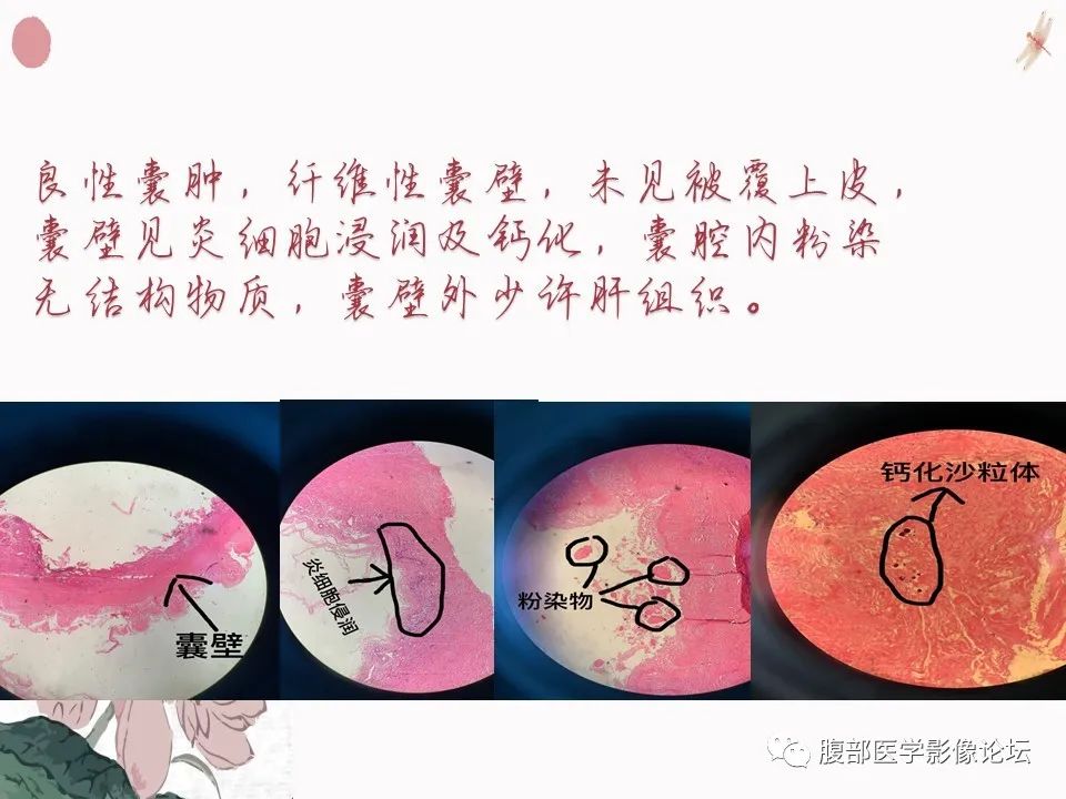 【PPT】肝脏良性囊肿影像诊断