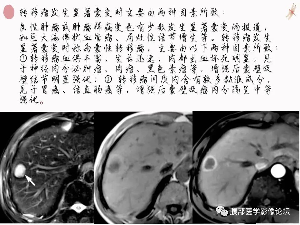 【PPT】肝脏良性囊肿影像诊断