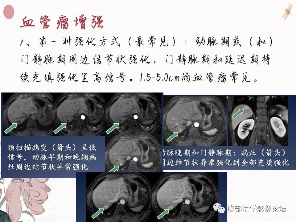 【PPT】肝脏良性囊肿影像诊断