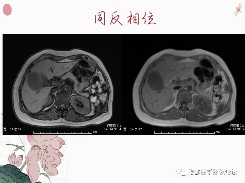 【PPT】肝脏良性囊肿影像诊断