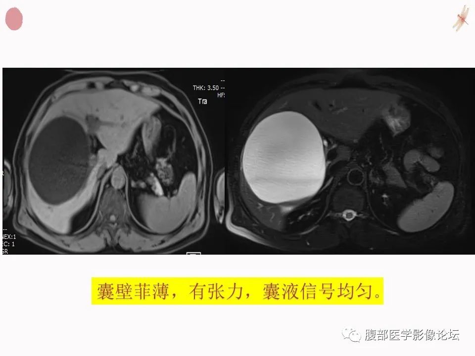 【PPT】肝脏良性囊肿影像诊断