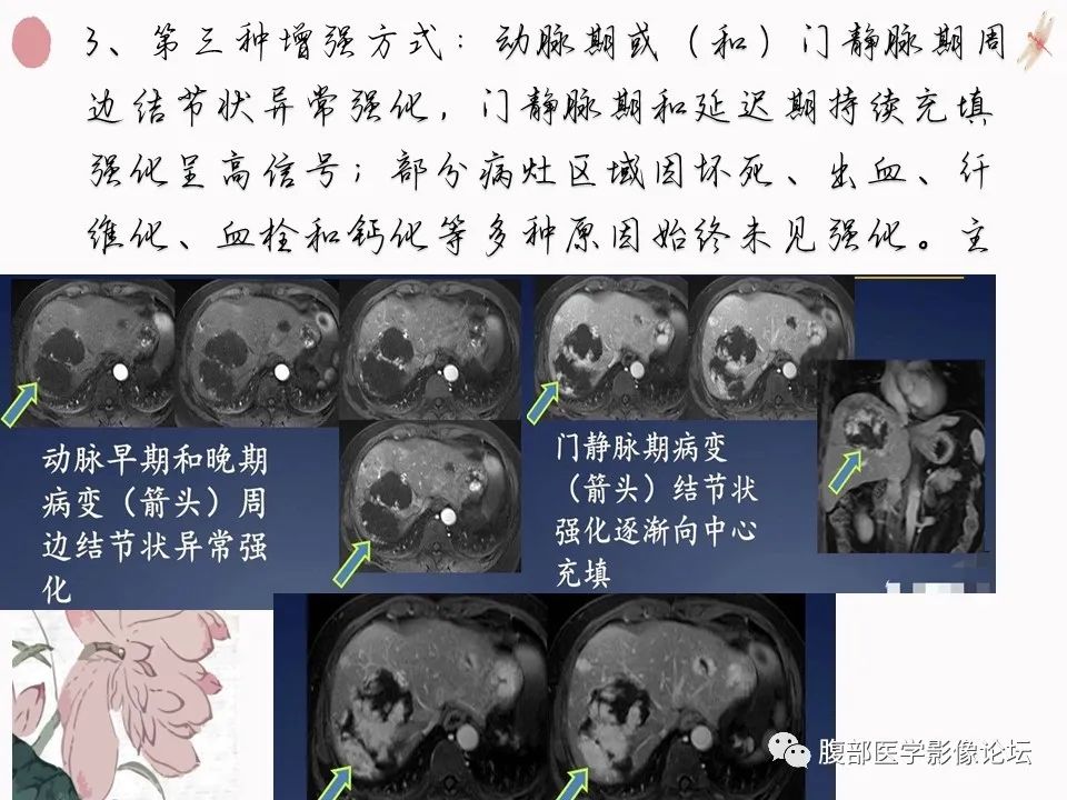 【PPT】肝脏良性囊肿影像诊断
