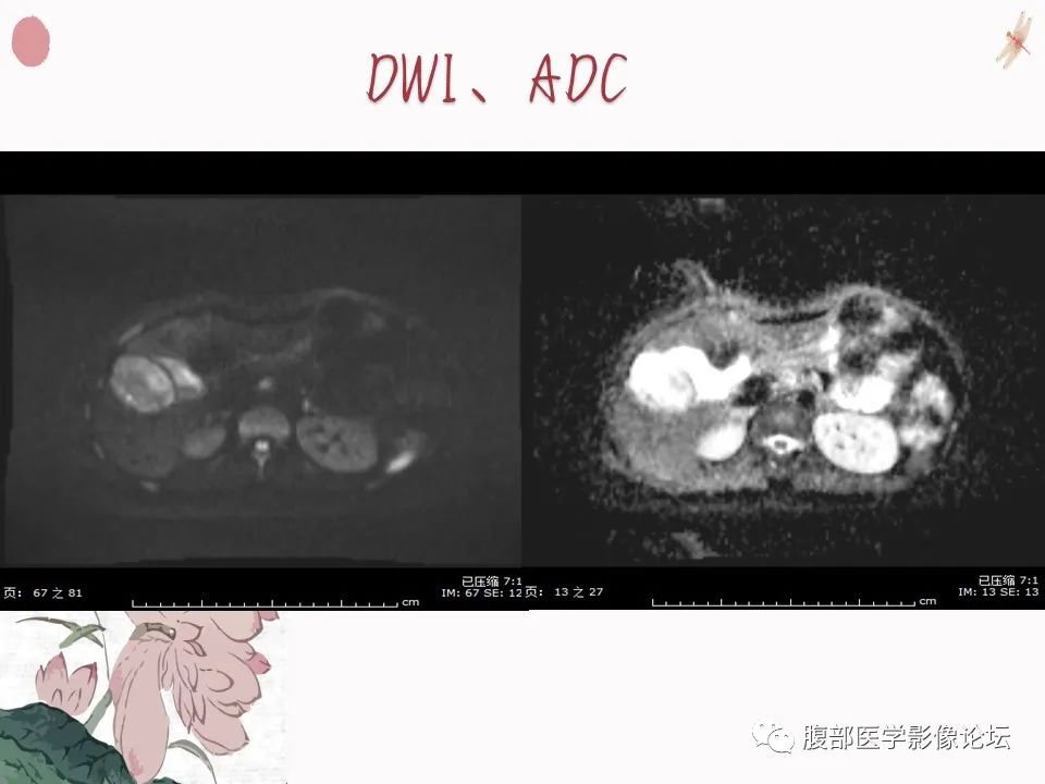 【PPT】肝脏良性囊肿影像诊断
