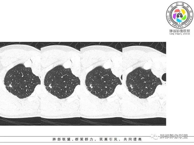 【病例】肺部实性小结节1例影像讨论分析