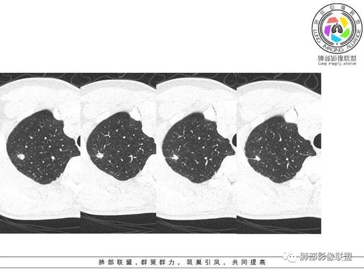 【病例】肺部实性小结节1例影像讨论分析