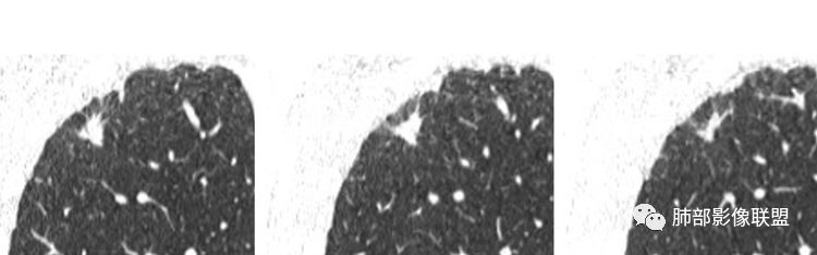 【病例】肺部实性小结节1例影像讨论分析