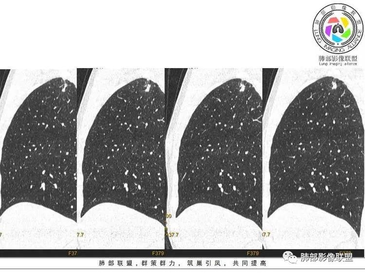 【病例】肺部实性小结节1例影像讨论分析