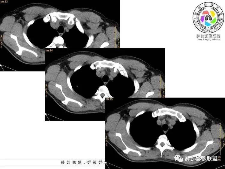 【病例】肺部实性小结节1例影像讨论分析