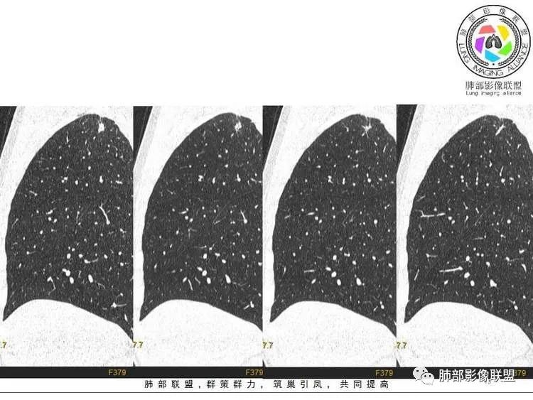 【病例】肺部实性小结节1例影像讨论分析