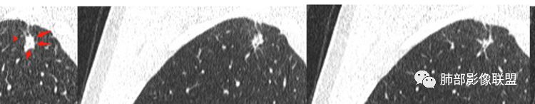 【病例】肺部实性小结节1例影像讨论分析