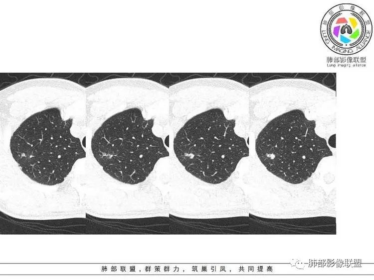 【病例】肺部实性小结节1例影像讨论分析