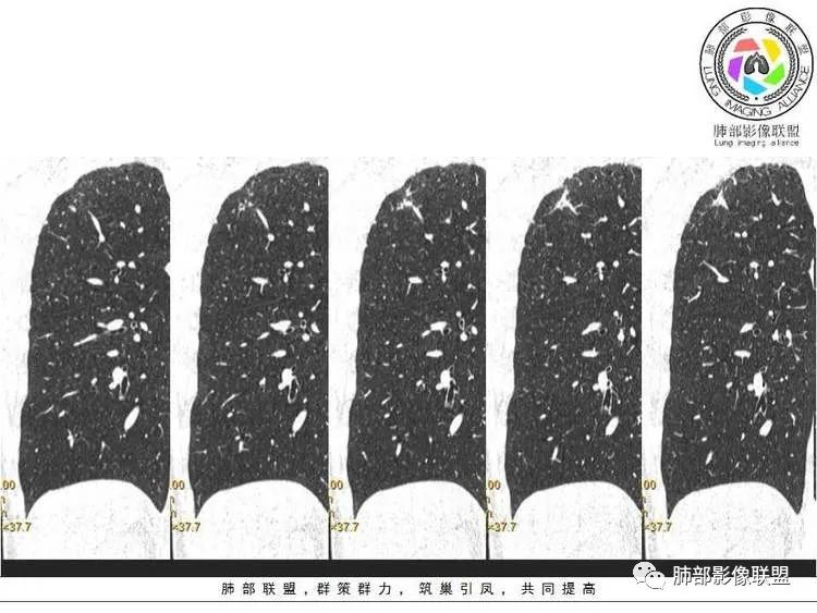 【病例】肺部实性小结节1例影像讨论分析