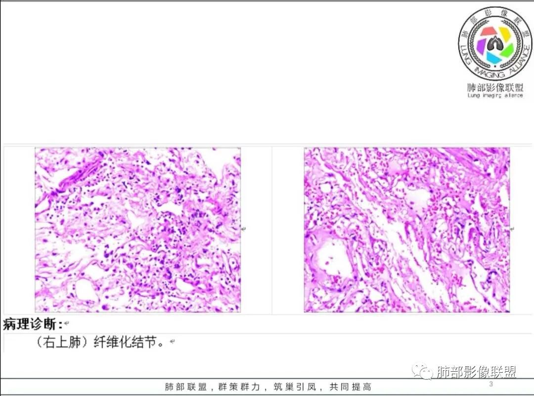【病例】肺部实性小结节1例影像讨论分析