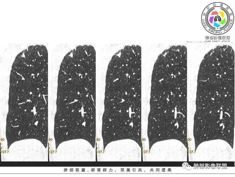 【病例】肺部实性小结节1例影像讨论分析