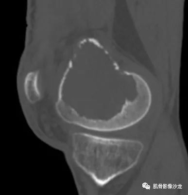 【病例】股骨下端骨巨细胞瘤1例CT及MR影像表现
