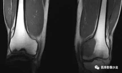 【病例】股骨下端骨巨细胞瘤1例CT及MR影像表现