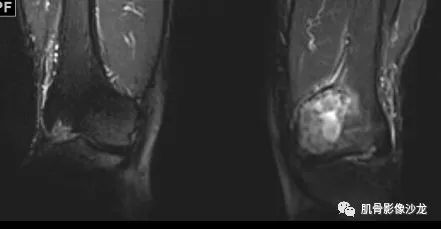 【病例】股骨下端骨巨细胞瘤1例CT及MR影像表现