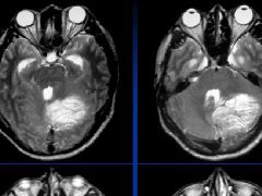 小脑发育不良性神经节细胞瘤的MRI诊断