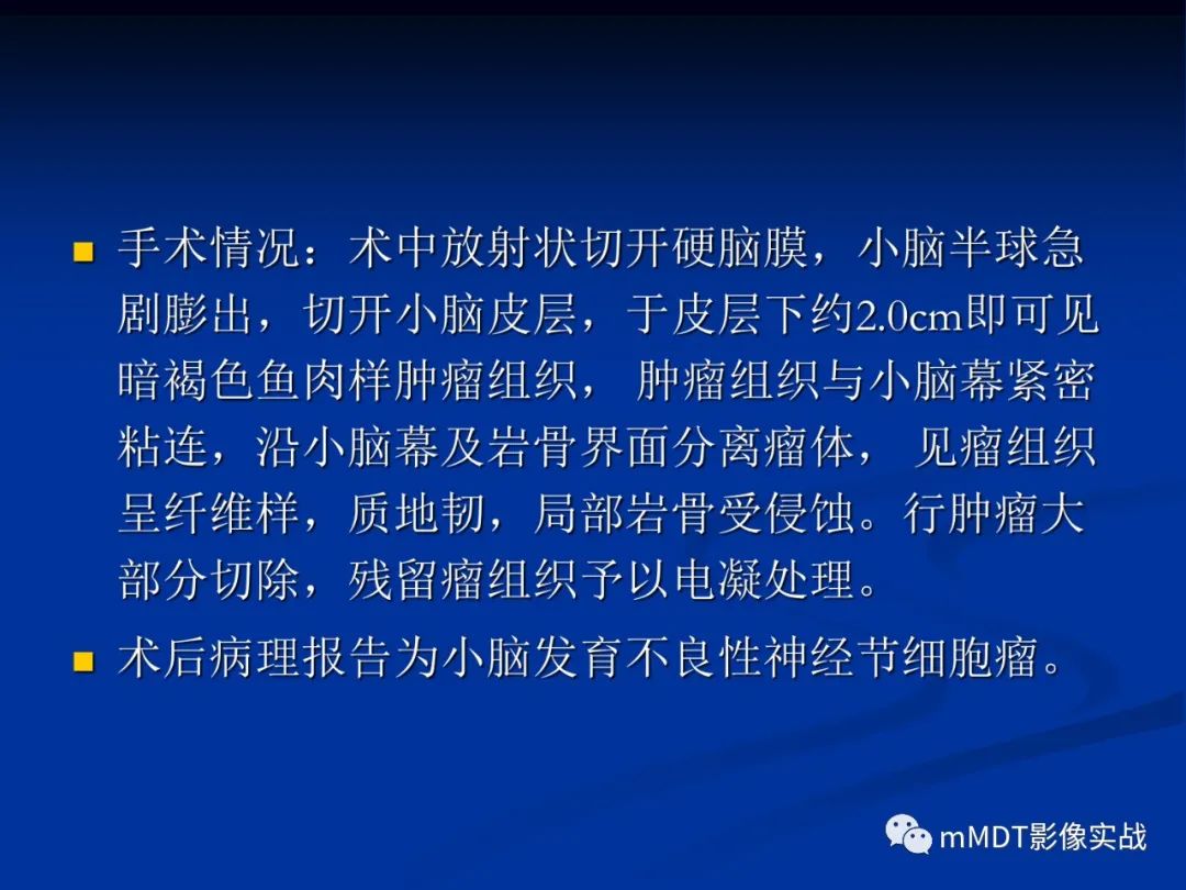 【PPT】小脑发育不良性神经节细胞瘤的MR诊断