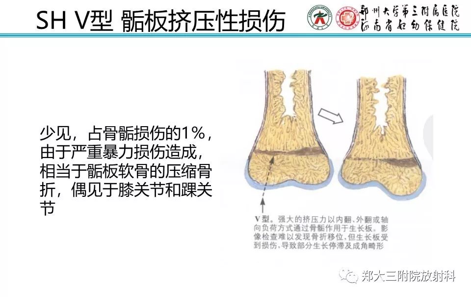 【PPT】骨骺损伤的影像诊断