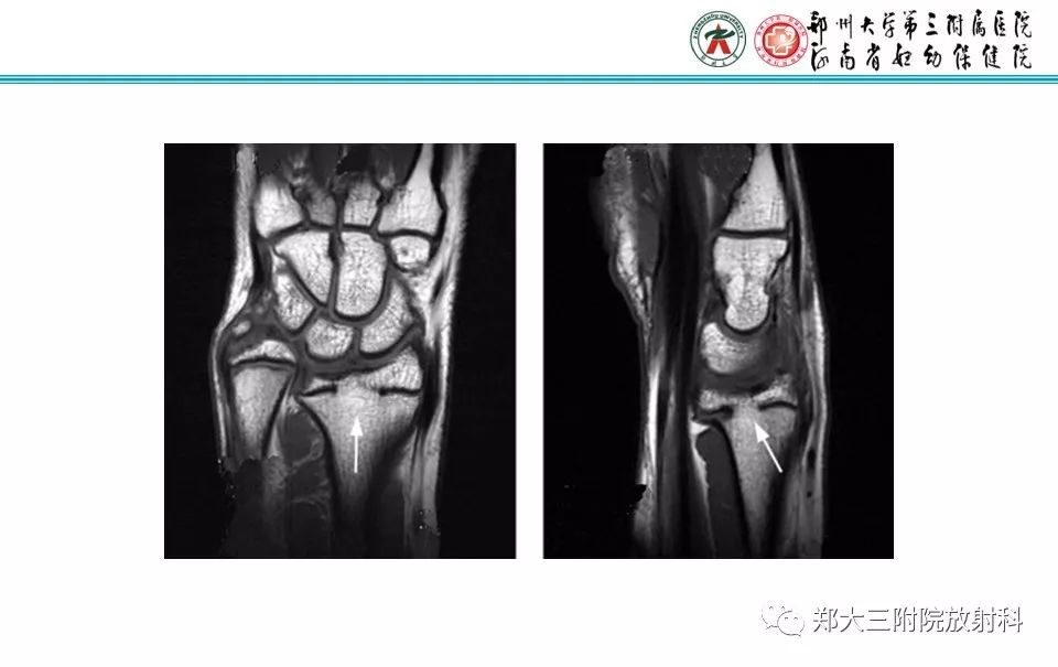 【PPT】骨骺损伤的影像诊断