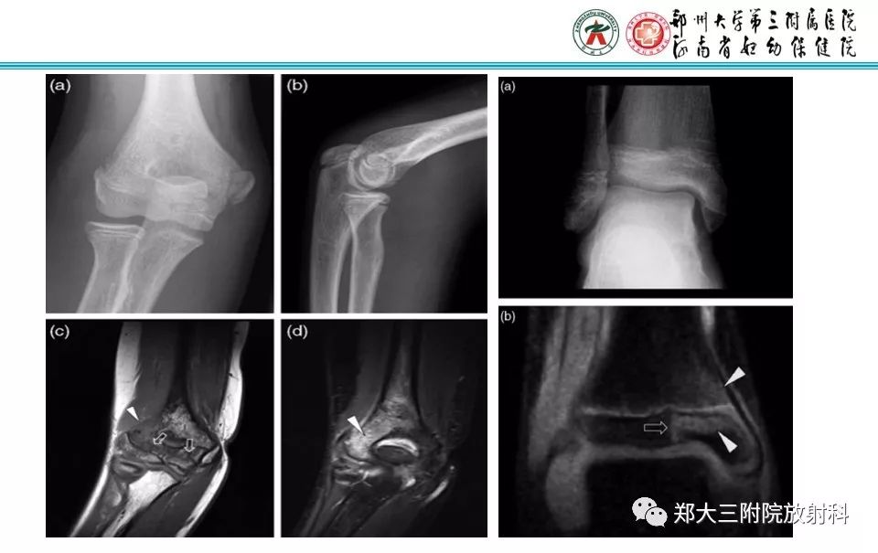 【PPT】骨骺损伤的影像诊断