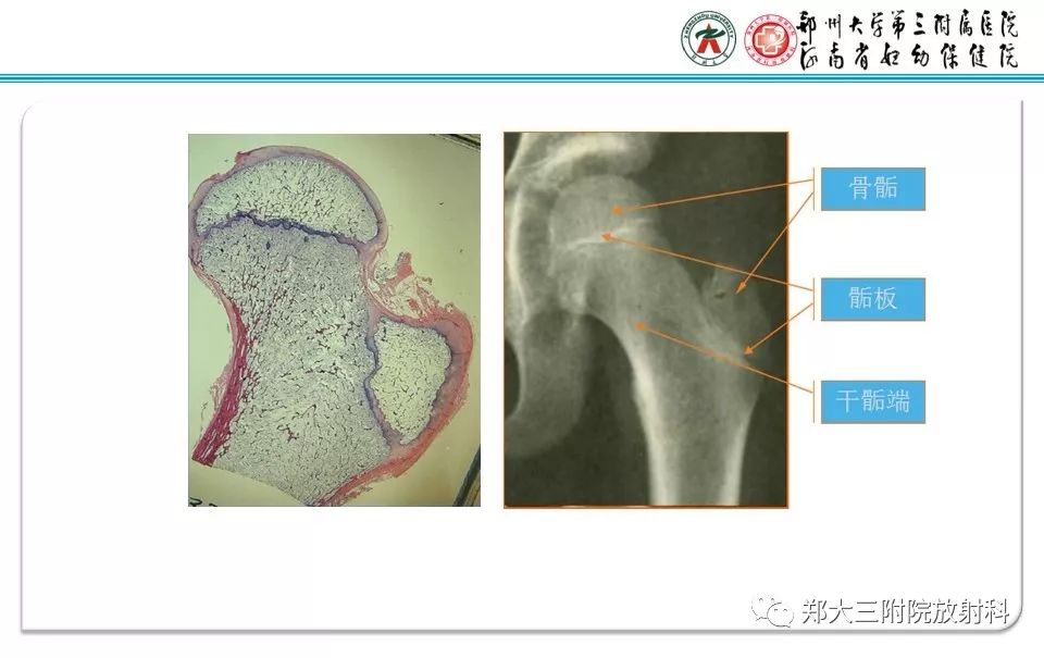 【PPT】骨骺损伤的影像诊断