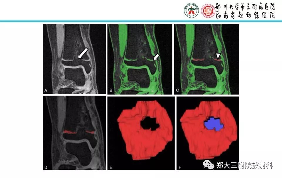 【PPT】骨骺损伤的影像诊断
