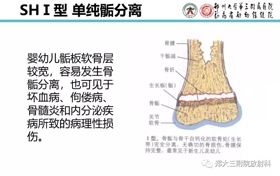 【PPT】骨骺损伤的影像诊断