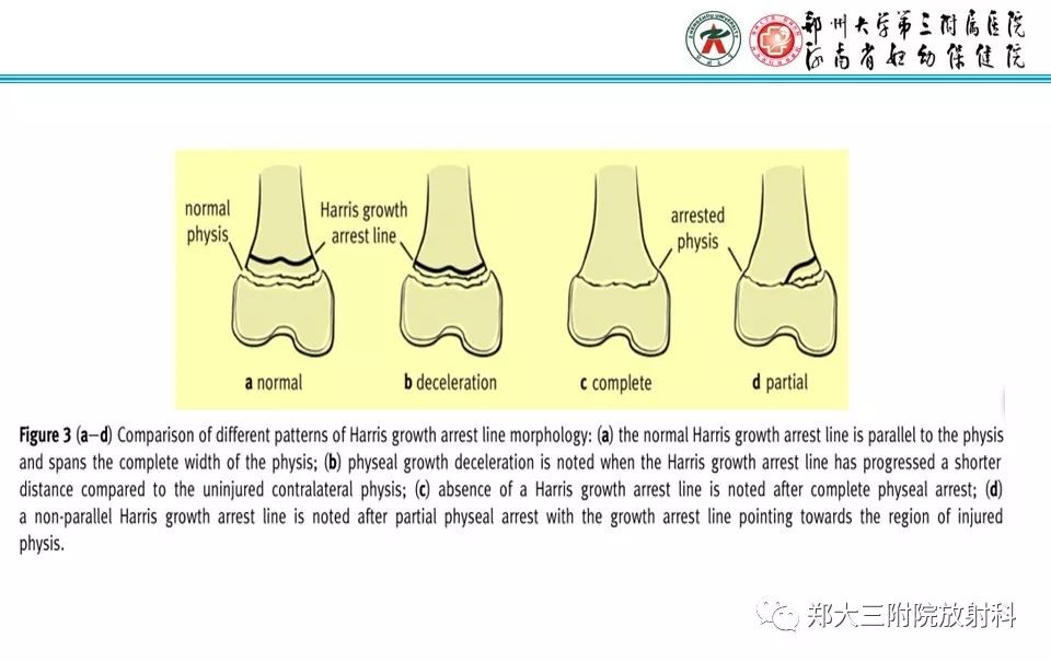 【PPT】骨骺损伤的影像诊断