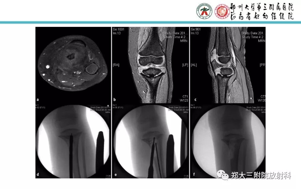 【PPT】骨骺损伤的影像诊断