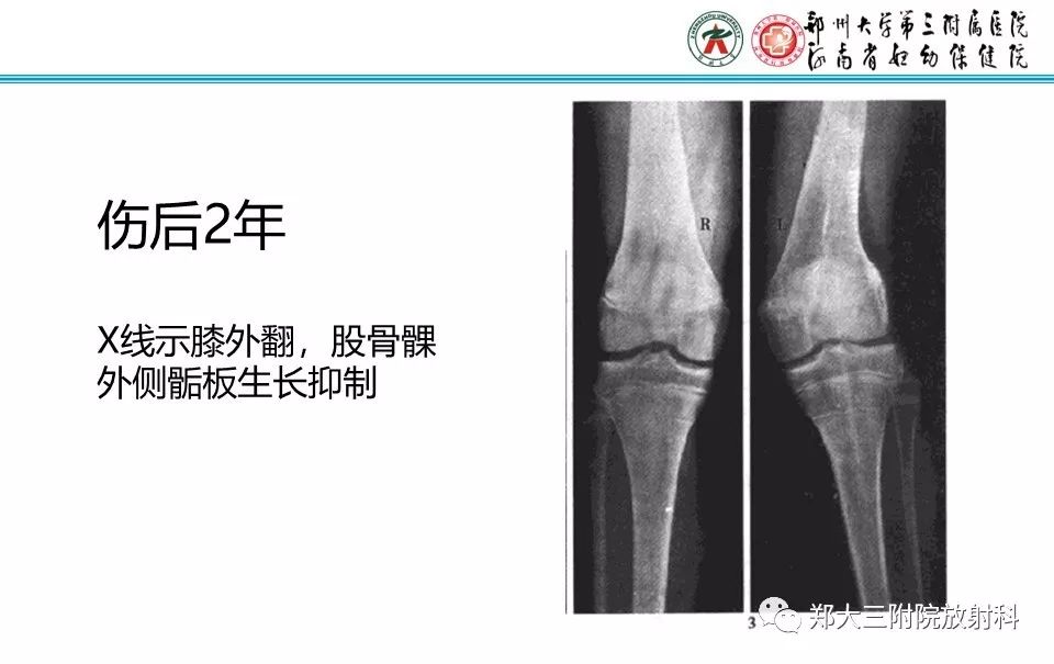 【PPT】骨骺损伤的影像诊断