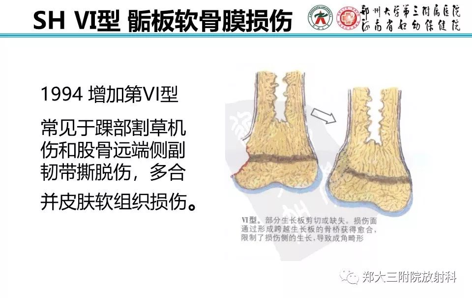 【PPT】骨骺损伤的影像诊断