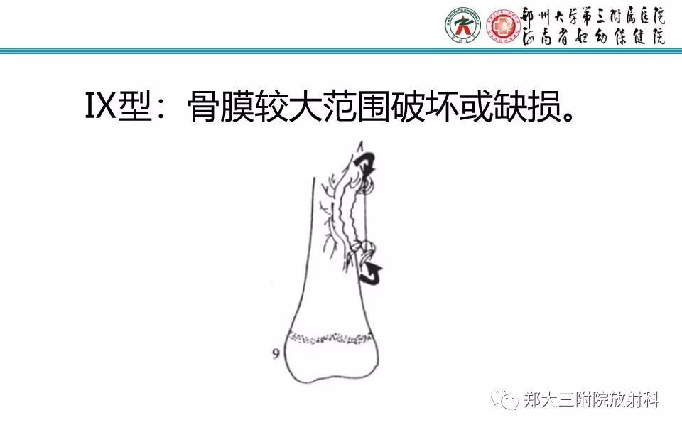 【PPT】骨骺损伤的影像诊断