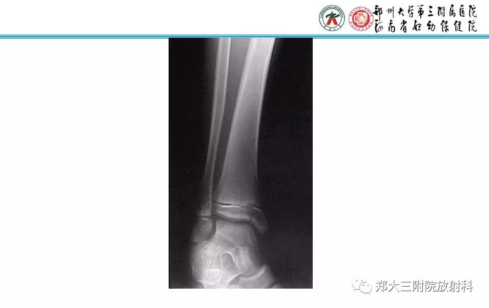 【PPT】骨骺损伤的影像诊断