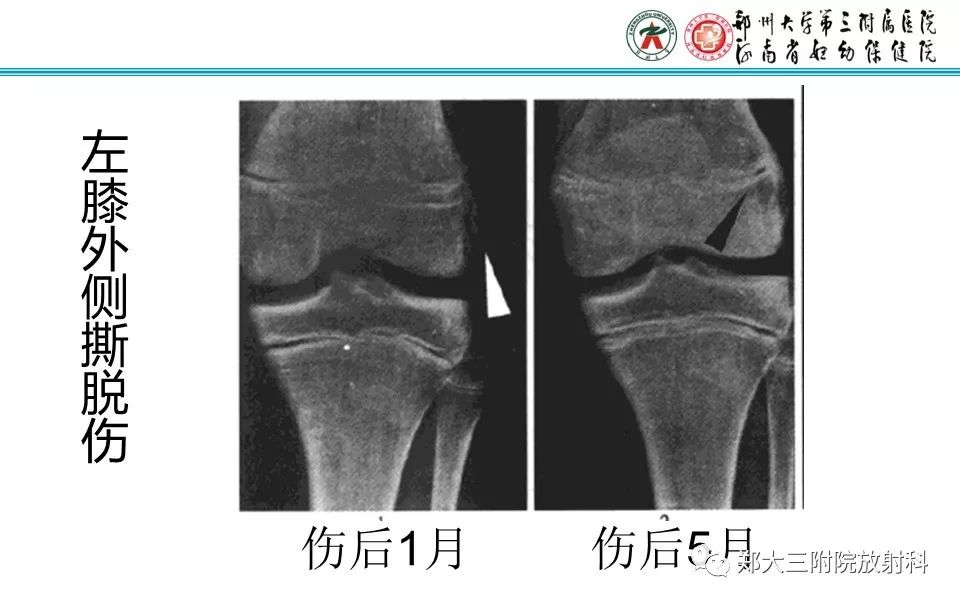【PPT】骨骺损伤的影像诊断