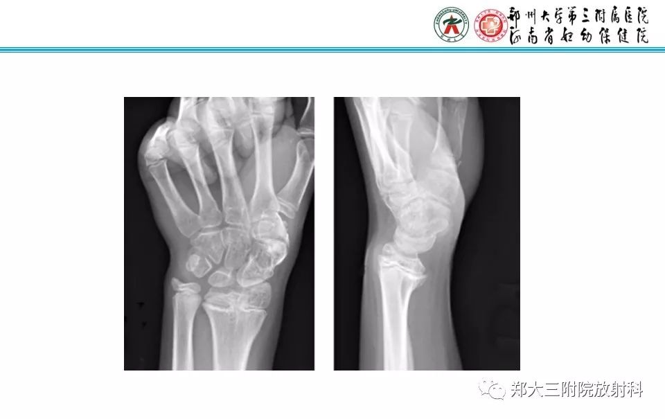 【PPT】骨骺损伤的影像诊断