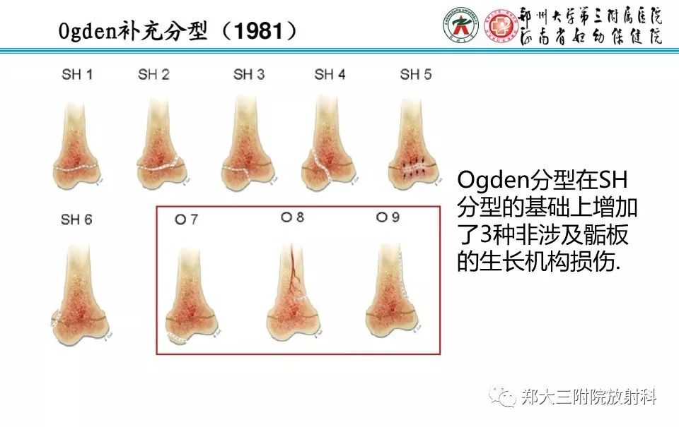 【PPT】骨骺损伤的影像诊断