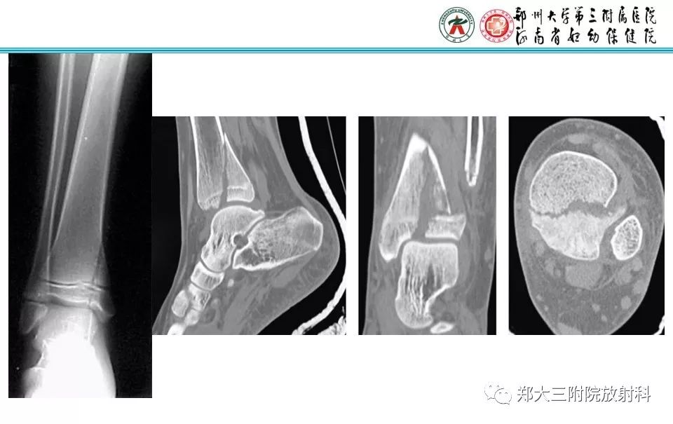 【PPT】骨骺损伤的影像诊断